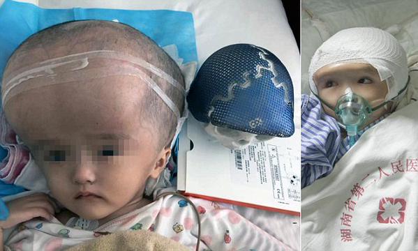 La première implantation crânienne totale effectuée par imprimante 3D voit le jour.