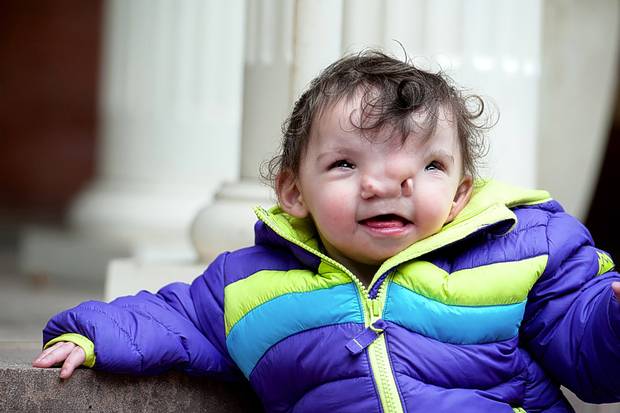Une petite fille acquiert un nouveau visage grâce à l'impression 3D