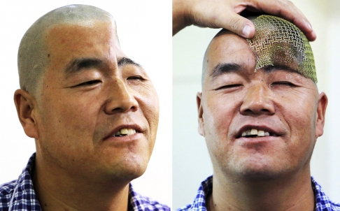 Un paysan chinois se fait imprimer un nouveau crâne!